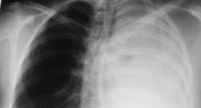 Left main bronchus foreign body masquerading as diaphragmatic hernia in an adult patient