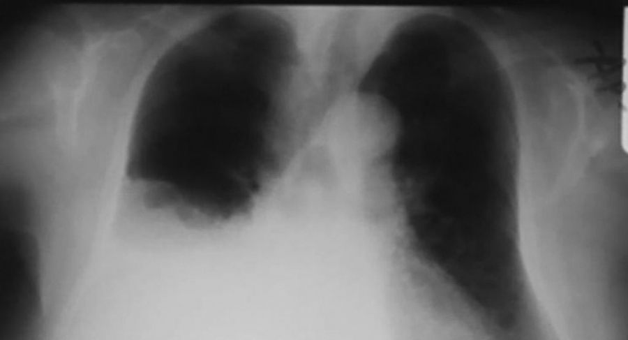 Successful pleurodesis for refractory chylothorax due to chronic lymphocytic leukemia